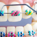 What are the different orthodontic treatments?