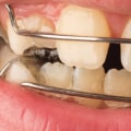 What is the difference between limited and comprehensive orthodontic treatment?
