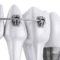 Are implants considered orthodontics?
