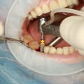 Enhance Orthodontics with Tooth Implants in North Little Rock