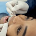 The Role Of Orthodontics In Preventing Gum Disease And Tooth Decay In Monroe, LA