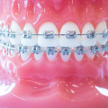 Everything You Should Expect During Your Orthodontic Treatment In New Jersey