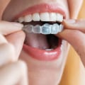 How Spark Aligners Are Used To Treat Various Orthodontic Conditions In London