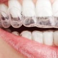 6 Warning Signs That You Need Invisalign Orthodontics Treatment In Spring, TX