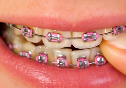 Protecting Your Smile After Invisalign Orthodontics Treatment In San Antonio