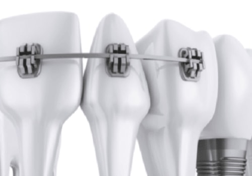 Are implants considered orthodontics?