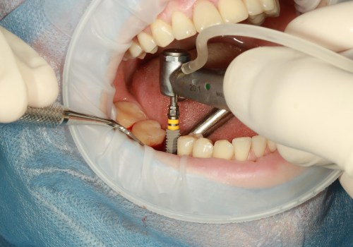 Enhance Orthodontics with Tooth Implants in North Little Rock