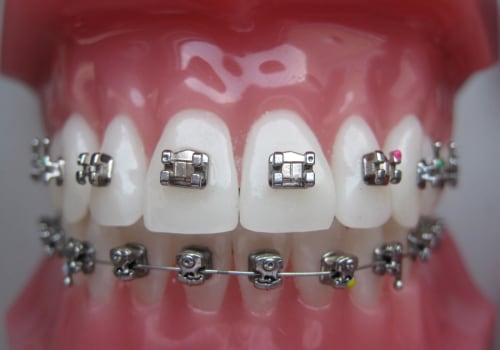 What are orthodontic fixed appliances?