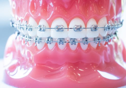 Everything You Should Expect During Your Orthodontic Treatment In New Jersey