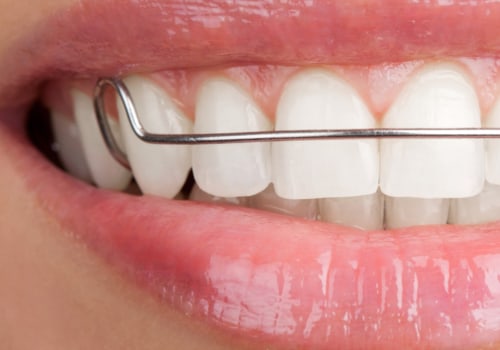 What is a full orthodontic treatment?