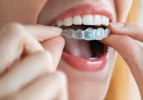 How Spark Aligners Are Used To Treat Various Orthodontic Conditions In London