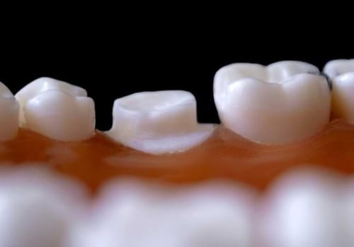 Is a dental crown considered orthodontic?