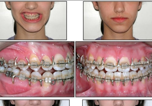 What are the 5 stages of braces?