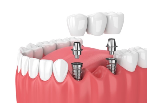 A Winning Combination: Orthodontics And Dental Implants In Georgetown For Ultimate Oral Health