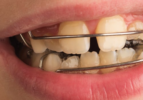 How Orthodontic Treatment Treats Dental Problems In Boerne, TX
