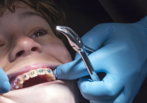What can be done instead of braces?