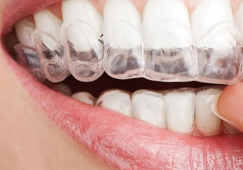 6 Warning Signs That You Need Invisalign Orthodontics Treatment In Spring, TX